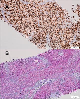 Case report: Robust response of metastatic clear cell sarcoma treated with cabozantinib and immunotherapy